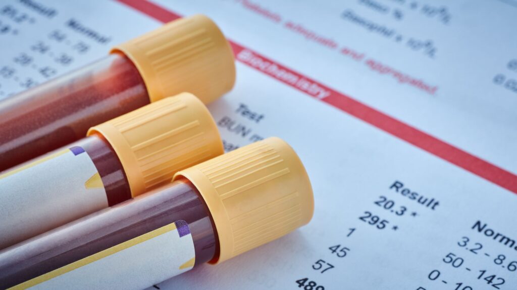 Three blood sample vials with yellow caps rest on a printed laboratory test results sheet displaying various numbers and test names.